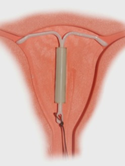 Mirena_IntraUterine_System.jpg